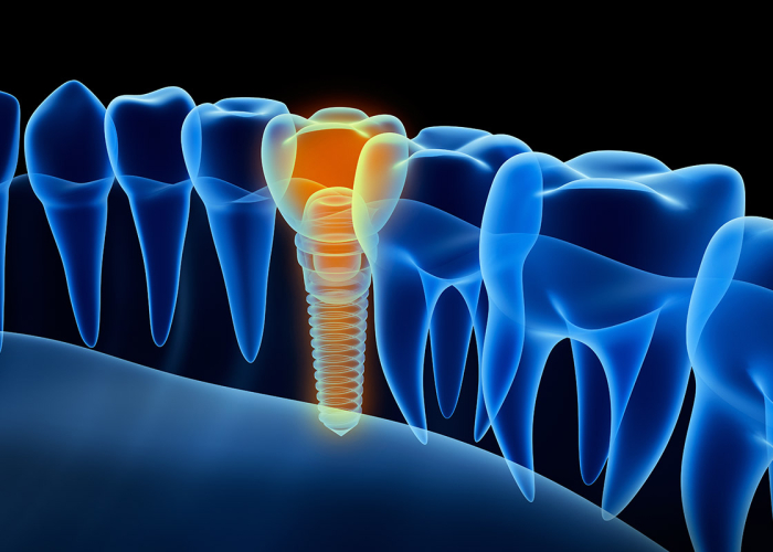 ¿Cómo funcionan los implantes dentales?